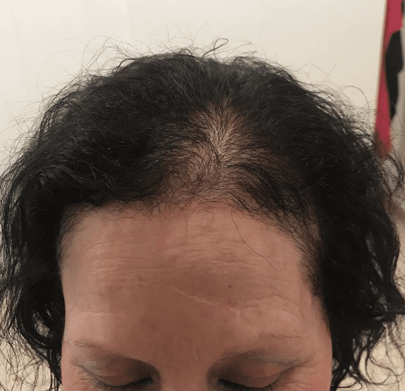Mujer con alopecia 